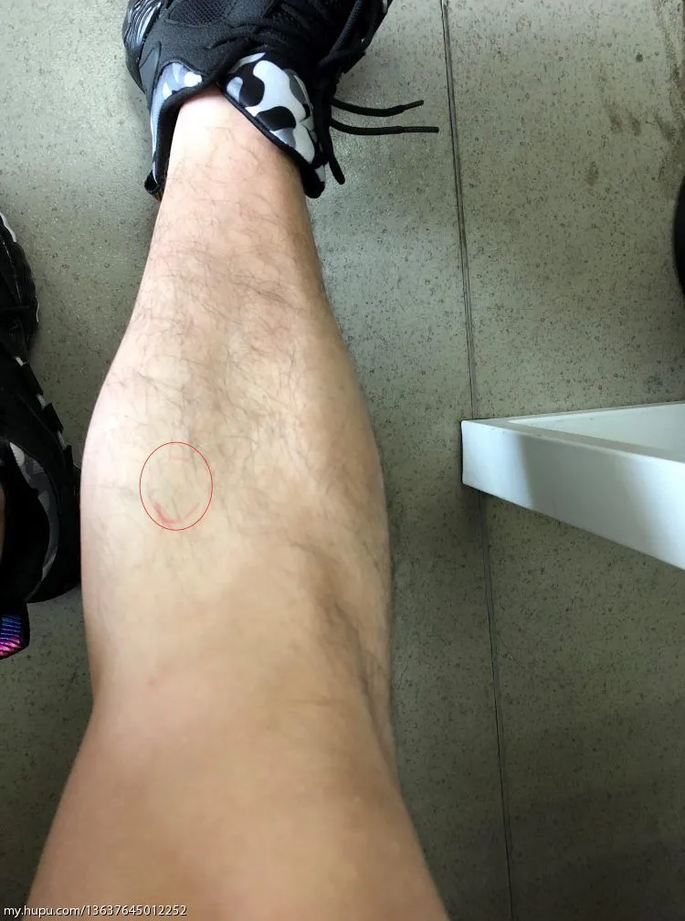 膝盖胫骨内侧按压疼痛 有类似症状的吗 健身和运动健康 虎扑社区