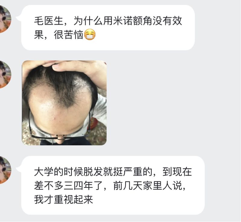 米诺地尔对前额脱发没效果 是真的吗 虎扑