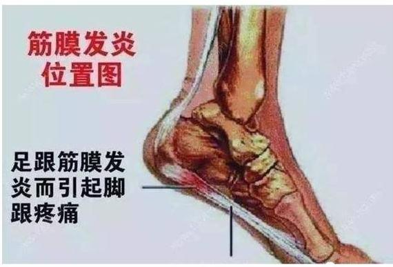 足底筋膜炎用什么药 虎扑