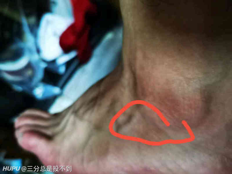 脚踝痛是怎么回事 虎扑