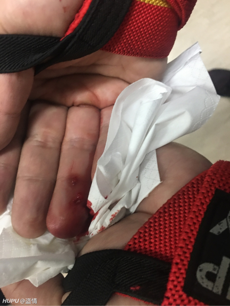 记录下我的右手无名指远端粉碎性骨折治疗史 多图 血腥 慎入 虎扑