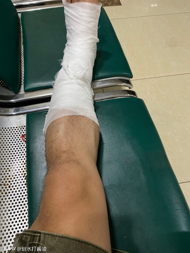 Hxdm打篮球腓骨骨折 虎扑