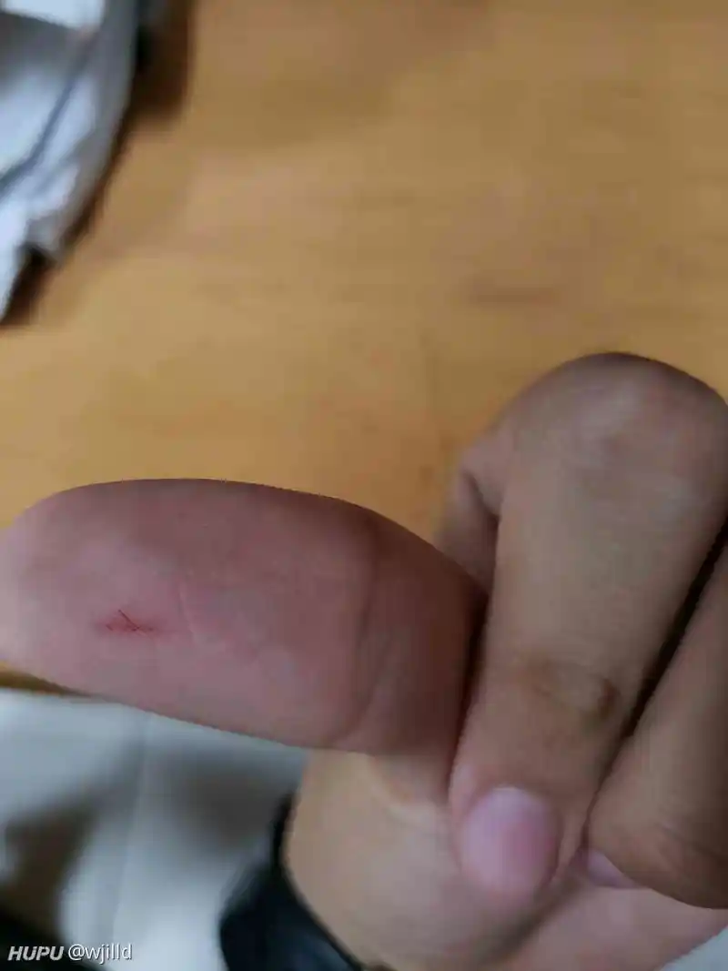 这样要打破伤风吗？