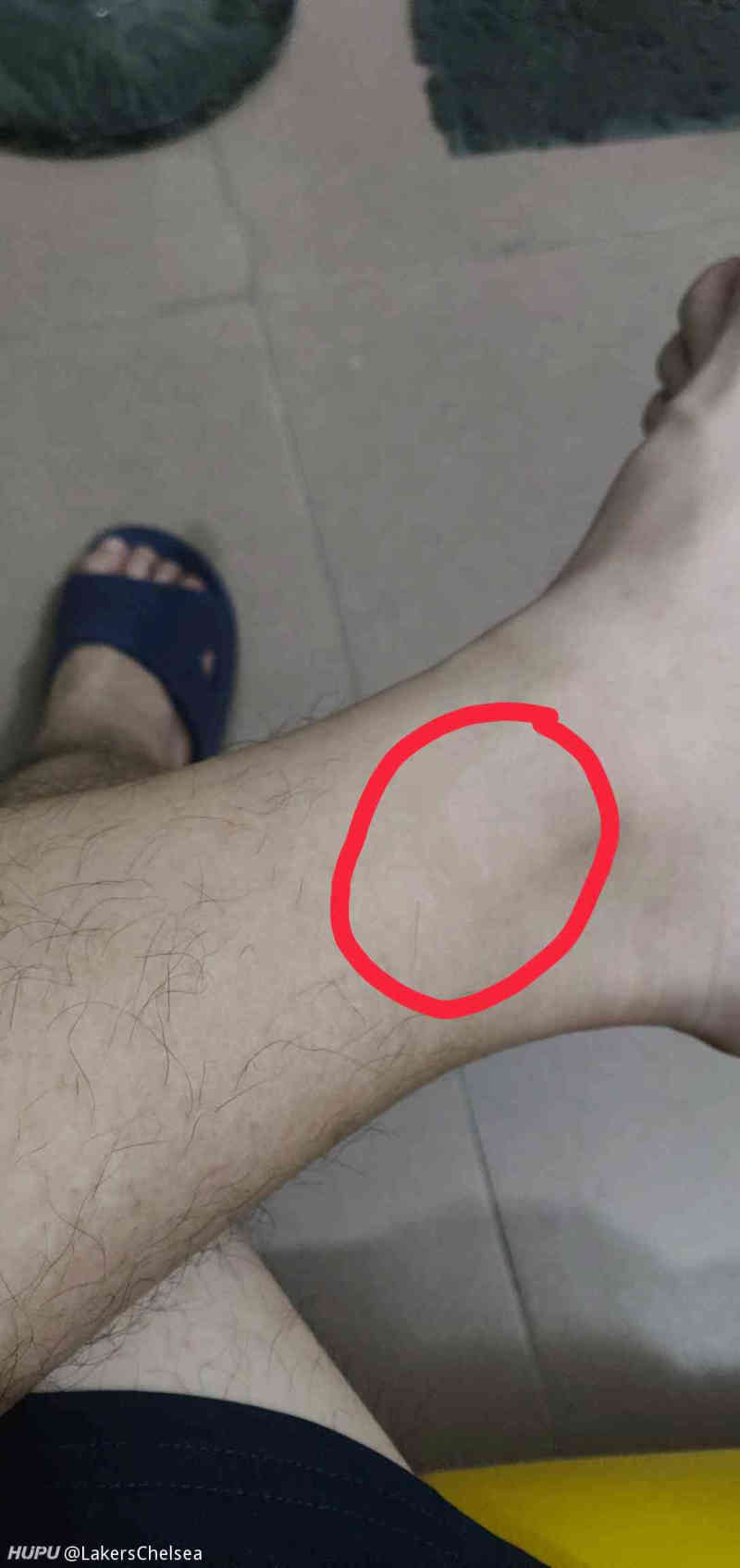 伤痛问题 有经验的来说说 虎扑