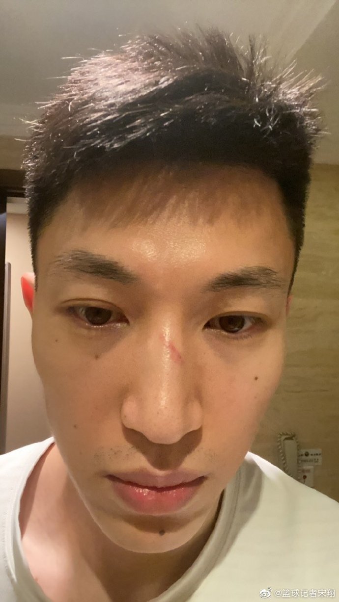 流言板 宋翔 刘晓宇鼻子部位再添血道 虎扑