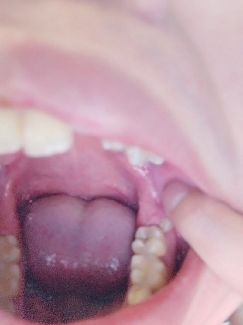 各位jrs 我长歪的这颗智齿难拔不 虎扑